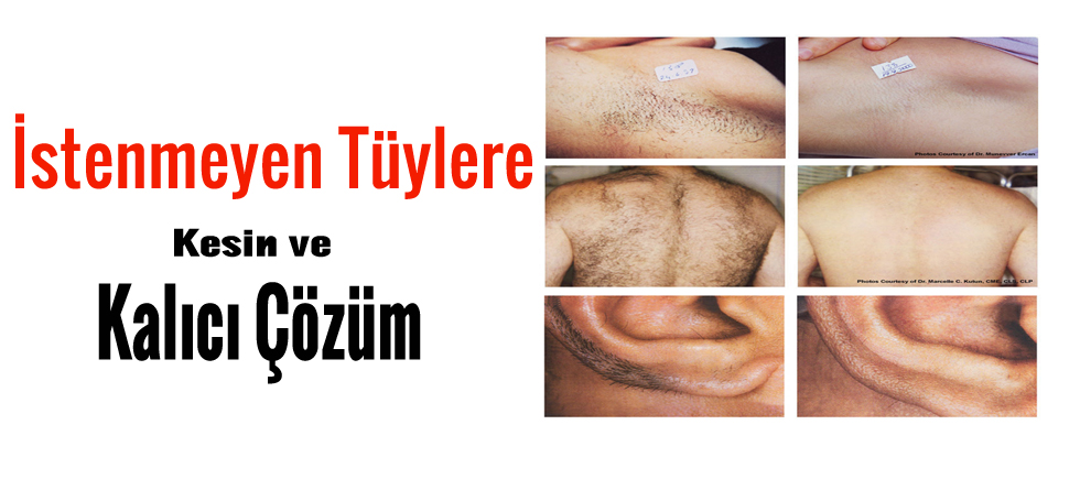 İstenmeyen Tüyler